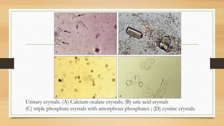 Urinary crystals. (A) Calcium oxalate crystals; (B) uric acid crystals
(C) triple phosphate crystals with amorphous phosphates ; (D) cystine crystals.
 
