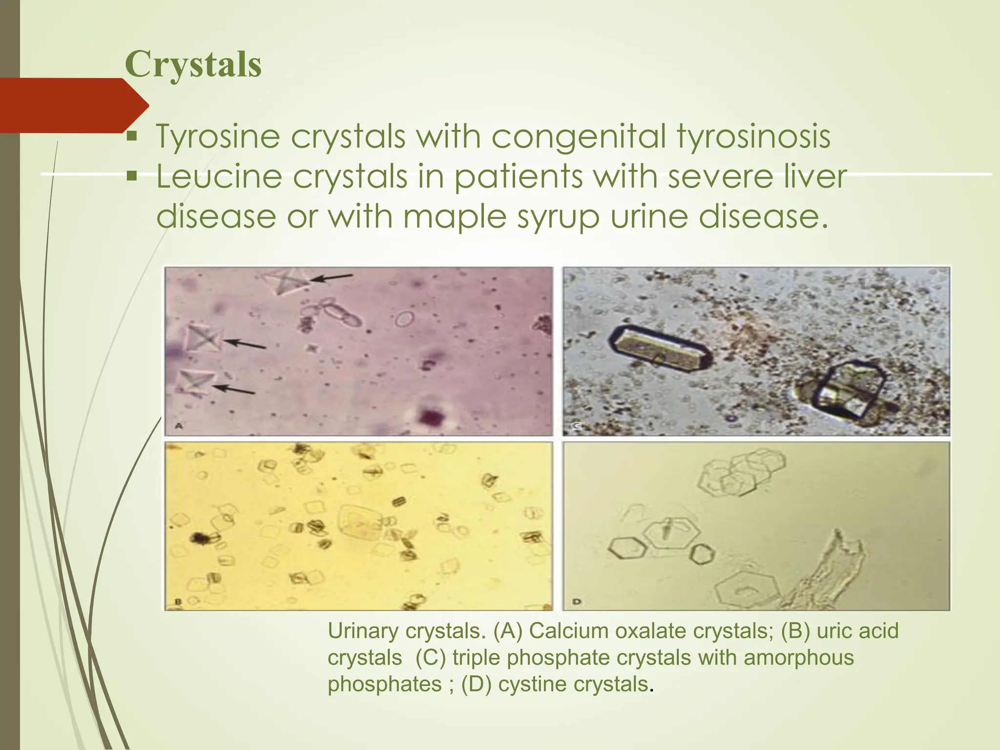 Urinary crystals. (A) Calcium oxalate crystals; (B) uric acid
crystals (C) triple phosphate crystals with amorphous
phosphates ; (D) cystine crystals.
Crystals
▪ Tyrosine crystals with congenital tyrosinosis
▪ Leucine crystals in patients with severe liver
disease or with maple syrup urine disease.
 