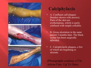 calciphylaxis treatment uptodate