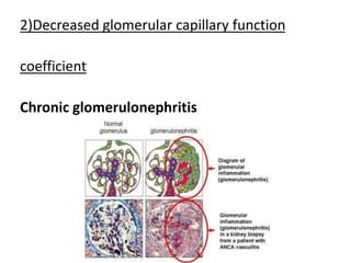 2)Decreased glomerular capillary function
coefficient
Chronic glomerulonephritis
 