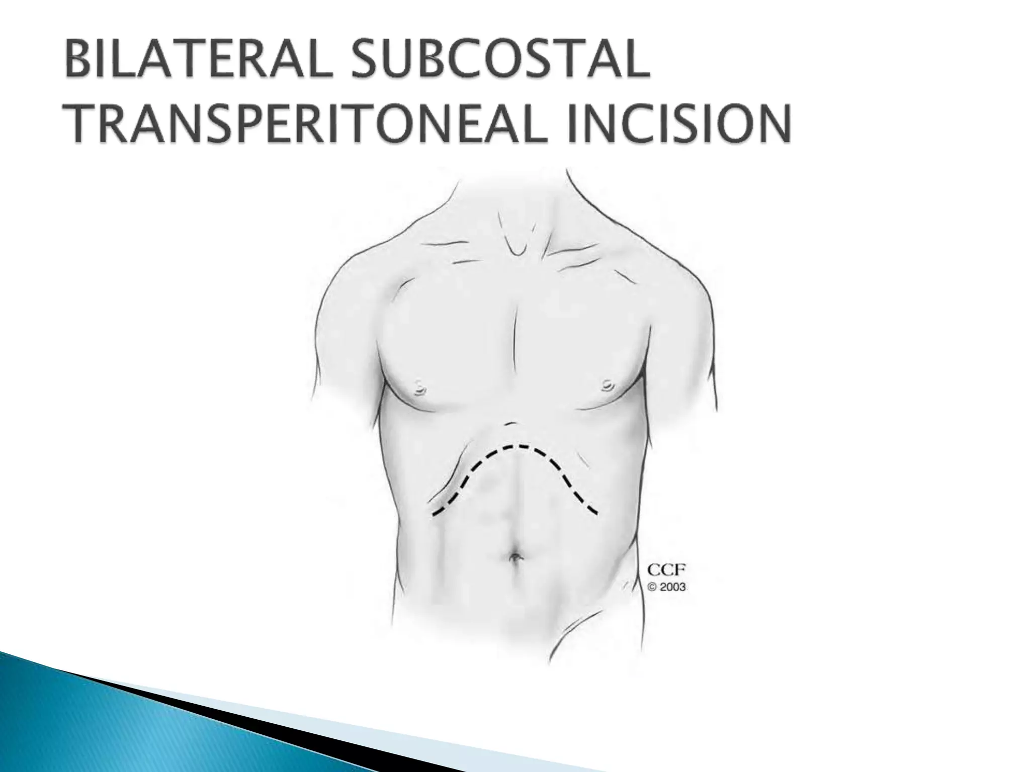 Flank Inscison Renal incision | PPTX