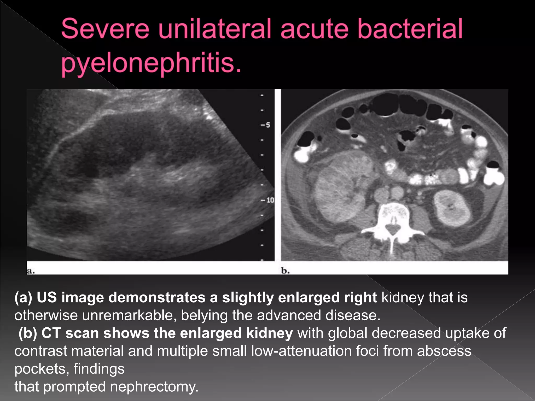 (a) US image demonstrates a slightly enlarged right kidney that is
otherwise unremarkable, belying the advanced disease.
(b) CT scan shows the enlarged kidney with global decreased uptake of
contrast material and multiple small low-attenuation foci from abscess
pockets, findings
that prompted nephrectomy.
 