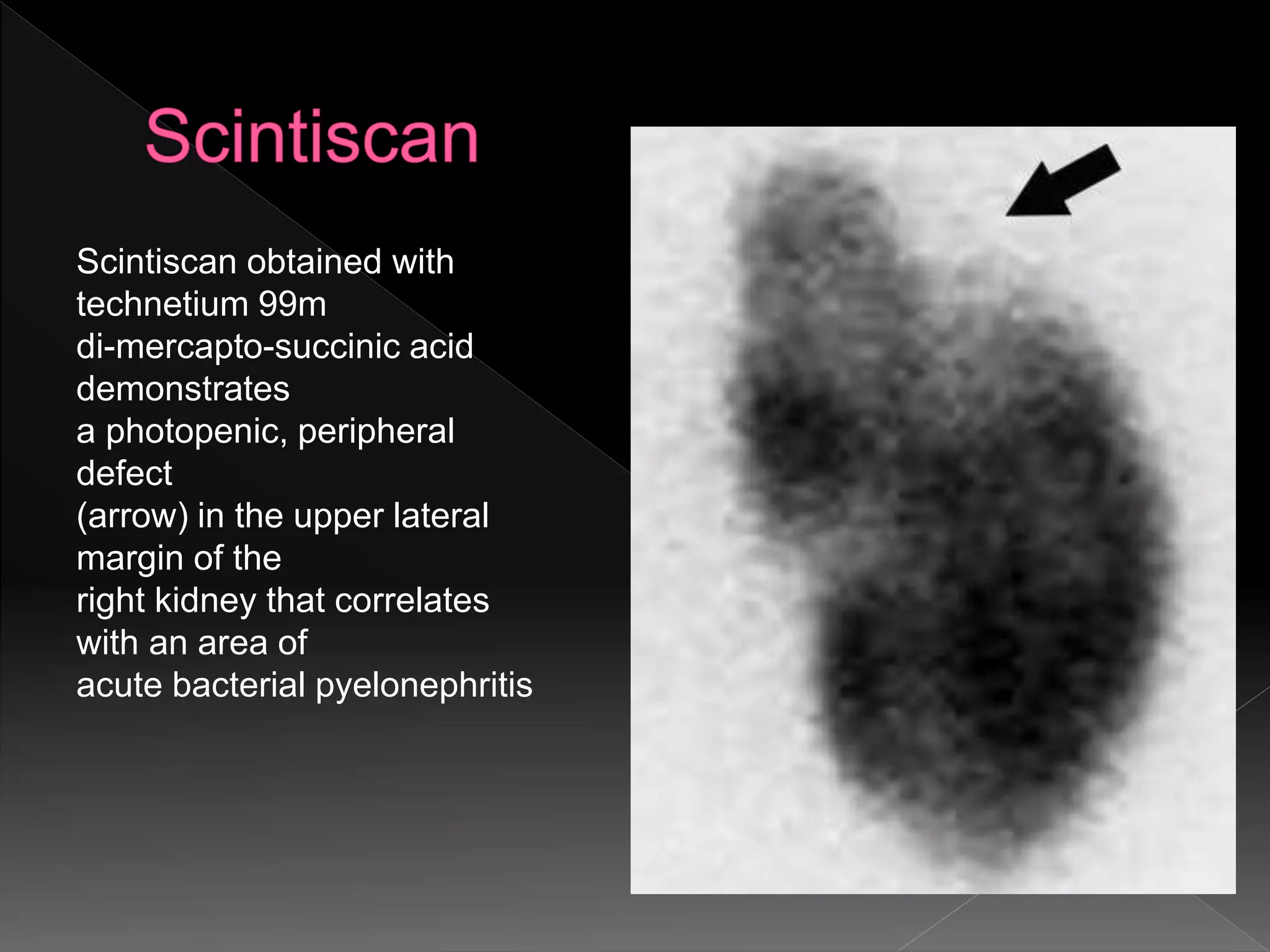 Scintiscan obtained with
technetium 99m
di-mercapto-succinic acid
demonstrates
a photopenic, peripheral
defect
(arrow) in the upper lateral
margin of the
right kidney that correlates
with an area of
acute bacterial pyelonephritis
 