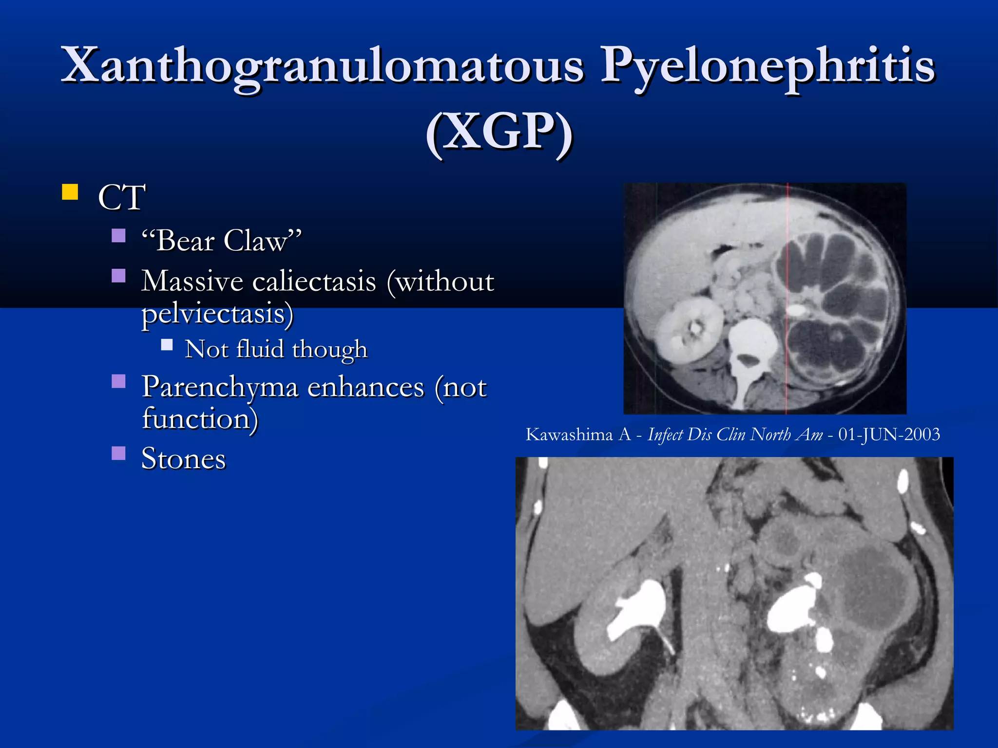 Renal inflammatory disease | PPT