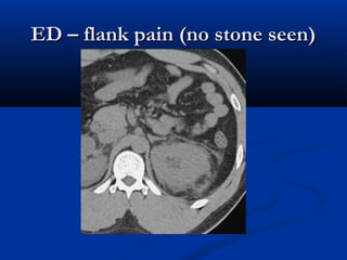 ED – flank pain (no stone seen)

 