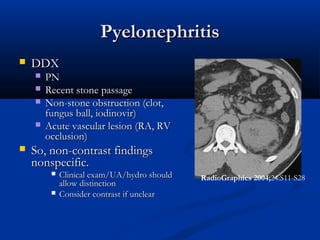 Pyelonephritis


DDX







PN
Recent stone passage
Non-stone obstruction (clot,
fungus ball, iodinovir)
Acute vascular lesion (RA, RV
occlusion)

So, non-contrast findings
nonspecific.



Clinical exam/UA/hydro should
allow distinction
Consider contrast if unclear

RadioGraphics 2004;24:S11-S28

 