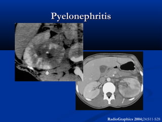 Pyelonephritis

RadioGraphics 2004;24:S11-S28

 
