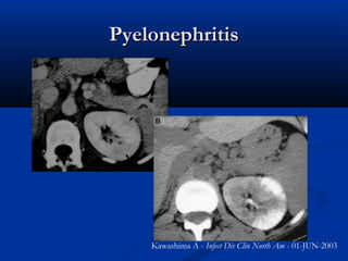 Pyelonephritis

Kawashima A - Infect Dis Clin North Am - 01-JUN-2003

 