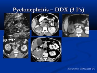 Pyelonephritis – DDX (3 I’s)

Radiographics. 2000;20:215-243

 