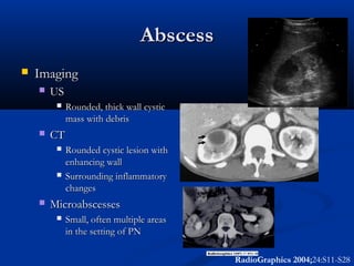 Abscess


Imaging


US




CT






Rounded, thick wall cystic
mass with debris
Rounded cystic lesion with
enhancing wall
Surrounding inflammatory
changes

Microabscesses


Small, often multiple areas
in the setting of PN
RadioGraphics 2004;24:S11-S28

 