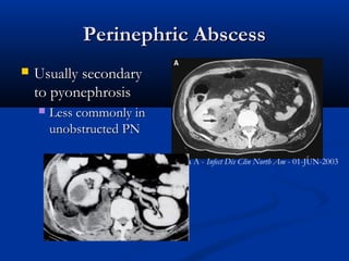 Perinephric Abscess


Usually secondary
to pyonephrosis


Less commonly in
unobstructed PN
Kawashima A - Infect Dis Clin North Am - 01-JUN-2003

 