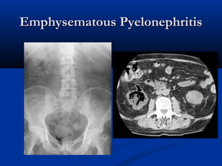 Emphysematous Pyelonephritis

 