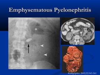 Emphysematous Pyelonephritis

Radiographics. 2002;22:543-561

 