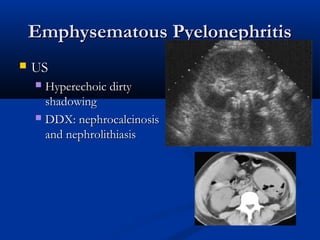 Emphysematous Pyelonephritis


US
Hyperechoic dirty
shadowing
 DDX: nephrocalcinosis
and nephrolithiasis


 