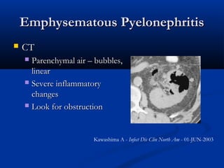 Emphysematous Pyelonephritis


CT
Parenchymal air – bubbles,
linear
 Severe inflammatory
changes
 Look for obstruction


Kawashima A - Infect Dis Clin North Am - 01-JUN-2003

 