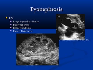 Pyonephrosis


US





Large, hypoechoic kidney
Hydronephrosis
Echogenic debris
Fluid – Fluid Level
Kawashima A - Infect Dis Clin North Am - 01-JUN-2003

 