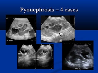 Pyonephrosis – 4 cases

 