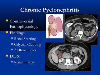 Chronic Pyelonephritis




Controversial
Pathophysiology
Findings
Renal Scarring
 Calyceal Clubbing
 At Renal Poles




DDX


Renal infarcts

 