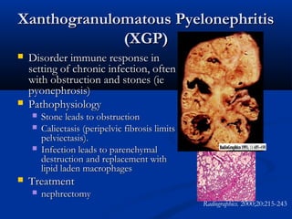 Xanthogranulomatous Pyelonephritis
(XGP)




Disorder immune response in
setting of chronic infection, often
with obstruction and stones (ie
pyonephrosis)
Pathophysiology






Stone leads to obstruction
Caliectasis (peripelvic fibrosis limits
pelviectasis).
Infection leads to parenchymal
destruction and replacement with
lipid laden macrophages

Treatment


nephrectomy

Radiographics. 2000;20:215-243

 