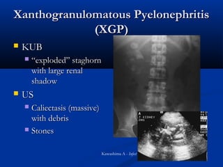 Xanthogranulomatous Pyelonephritis
(XGP)


KUB




“exploded” staghorn
with large renal
shadow

US
Caliectasis (massive)
with debris
 Stones


Kawashima A - Infect Dis Clin North Am - 01-JUN-2003

 