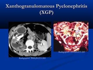 Xanthogranulomatous Pyelonephritis
(XGP)

Radiographics. 2000;20:215-243
Radiographics. 2000;20:215-243

 