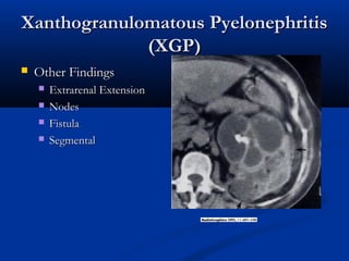Xanthogranulomatous Pyelonephritis
(XGP)


Other Findings





Extrarenal Extension
Nodes
Fistula
Segmental

 