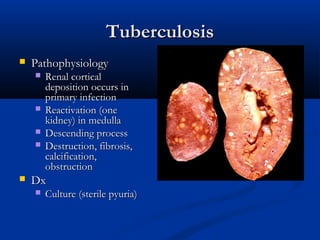 Tuberculosis


Pathophysiology








Renal cortical
deposition occurs in
primary infection
Reactivation (one
kidney) in medulla
Descending process
Destruction, fibrosis,
calcification,
obstruction

Dx


Culture (sterile pyuria)

 