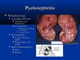 Pyelonephritis


Pathophysiology


Ascending Infection



Adhesions and
Endotoxins
Ureteropyelitis





Pyelonephritis





Thickened, enhancing
Urothelium
Ureteral “ileus”

Access/spread via
papilla
Wedge shaped and
patchy

Rarely hematogeneous



Staph
Bilateral

 