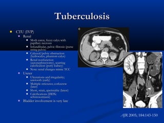 Tuberculosis


CTU (IVP)


Renal









Ureter







Moth eaten, fuzzy calyx with
papillary necrosis
Infundibular, pelvic fibrosis (purse
string pelvis)
Calyceal/pelvic obstruction
(hydrocalyx, phantom calyx)
Renal nonfunction
(autonephrectomy), scarring
calcification (putty kidney)
Note: renal changes mimic TCC
Ulcerations and irregularity;
sawtooth (early)
Multiple strictures; corkscrew
(later)
Short, strait, aperistaltic (latest)
Calcifications (DDX:
schistosomiasis)

Bladder involvement is very late

AJR 2005; 184:143-150

 