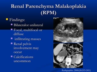 Renal Parenchyma Malakoplakia
(RPM)


Findings:
Bilateralor unilateral
 Focal, multifocal or
diffuse
 infiltrating masses
 Renal pelvis
involvement may
occur
 Calcifications
uncommon


Radiographics. 2000;20:215-243.)

 