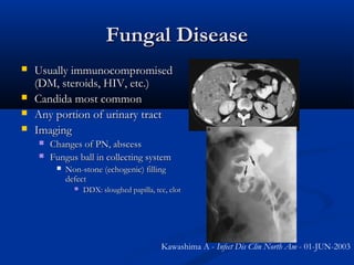 Fungal Disease





Usually immunocompromised
(DM, steroids, HIV, etc.)
Candida most common
Any portion of urinary tract
Imaging



Changes of PN, abscess
Fungus ball in collecting system


Non-stone (echogenic) filling
defect


DDX: sloughed papilla, tcc, clot

Kawashima A - Infect Dis Clin North Am - 01-JUN-2003

 