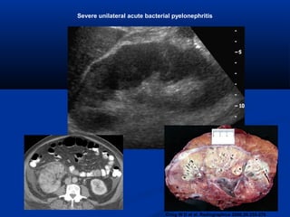 Severe unilateral acute bacterial pyelonephritis

Craig W D et al. Radiographics 2008;28:255-276

 