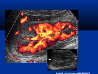 Craig W D et al. Radiographics 2008;28:255-276

 