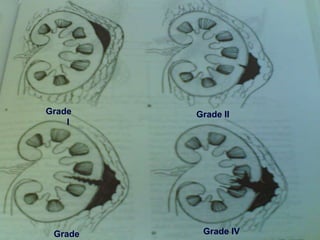 Grade
I
Grade II
Grade Grade IV
 