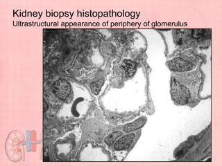 Kidney biopsy histopathology
Ultrastructural appearance of periphery of glomerulus
 