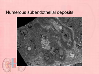 Numerous subendothelial deposits
 