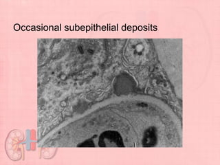 Occasional subepithelial deposits
 