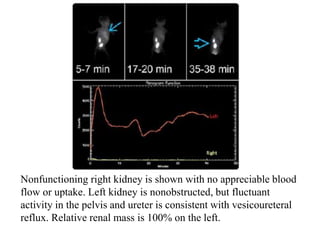 Nonfunctioning right kidney is shown with no appreciable blood
flow or uptake. Left kidney is nonobstructed, but fluctuant
activity in the pelvis and ureter is consistent with vesicoureteral
reflux. Relative renal mass is 100% on the left.
 
