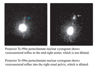 Posterior Tc-99m pertechnetate nuclear cystogram shows
vesicoureteral reflux to the mid right ureter, which is not dilated.
Posterior Tc-99m pertechnetate nuclear cystogram shows
vesicoureteral reflux into the right renal pelvis, which is dilated.
 