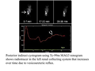 Posterior indirect cystogram using Tc-99m MAG3 renogram
shows radiotracer in the left renal collecting system that increases
over time due to vesicoureteric reflux.
 