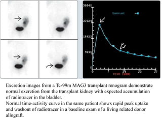 Excretion images from a Tc-99m MAG3 transplant renogram demonstrate
normal excretion from the transplant kidney with expected accumulation
of radiotracer in the bladder.
Normal time-activity curve in the same patient shows rapid peak uptake
and washout of radiotracer in a baseline exam of a living related donor
allograft.
 