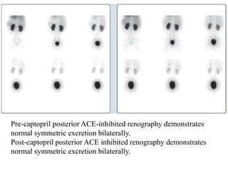 Pre-captopril posterior ACE-inhibited renography demonstrates
normal symmetric excretion bilaterally.
Post-captopril posterior ACE inhibited renography demonstrates
normal symmetric excretion bilaterally.
 