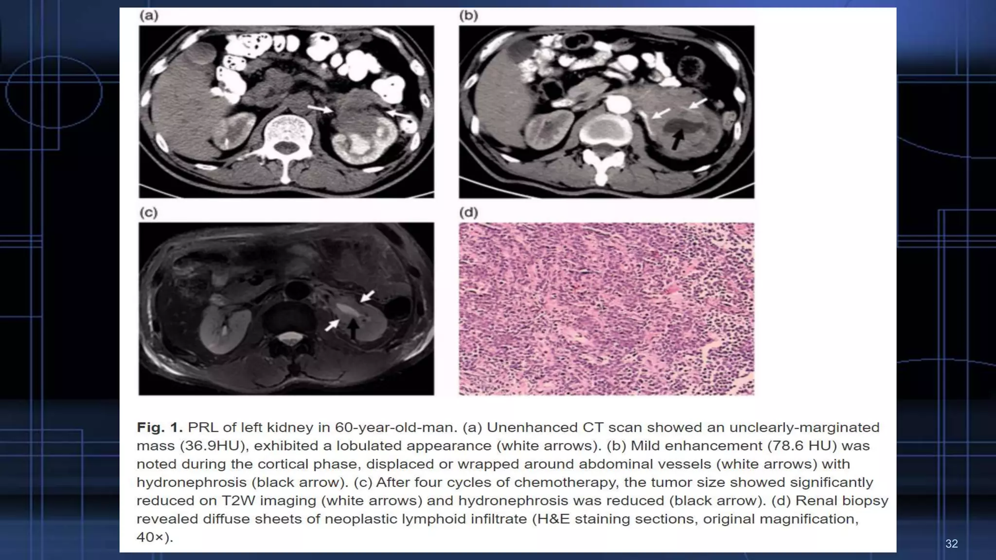 Renal Lymphoma PPTX Renal Lymphoma PPTX