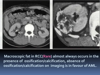 SOLID RENAL MASSES imaging | PPTX