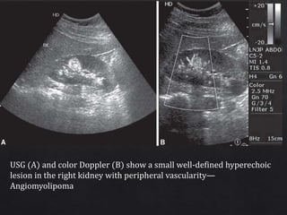 Imaging Of Renal Tumors PPTX Imaging Of Renal Tumors PPTX