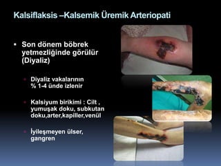 Kalsiflaksis –Kalsemik Üremik Arteriopati


 Son dönem böbrek
  yetmezliğinde görülür
  (Diyaliz)

   Diyaliz vakalarının
    % 1-4 ünde izlenir

   Kalsiyum birikimi : Cilt ,
    yumuşak doku, subkutan
    doku,arter,kapiller,venül

   İyileşmeyen ülser,
    gangren
 