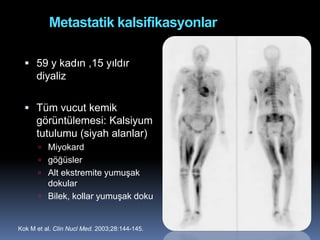 Metastatik kalsifikasyonlar

   59 y kadın ,15 yıldır
      diyaliz

   Tüm vucut kemik
      görüntülemesi: Kalsiyum
      tutulumu (siyah alanlar)
       Miyokard
       göğüsler
       Alt ekstremite yumuşak
        dokular
       Bilek, kollar yumuşak doku


Kok M et al. Clin Nucl Med. 2003;28:144-145.
 