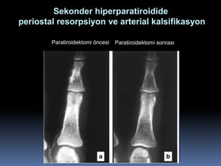 Sekonder hiperparatiroidide
periostal resorpsiyon ve arterial kalsifikasyon

        Paratiroidektomi öncesi   Paratiroidektomi sonrası
 