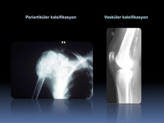 Periartiküler kalsifikasyon   Vasküler kalsifikasyon
 