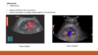 Power doppler Colour doppler
Ultrasound
• Hyperechoic
• Absence of flow in the renal artery
• Infarcts will appear as wedge-shaped regions of nonperfusion
 